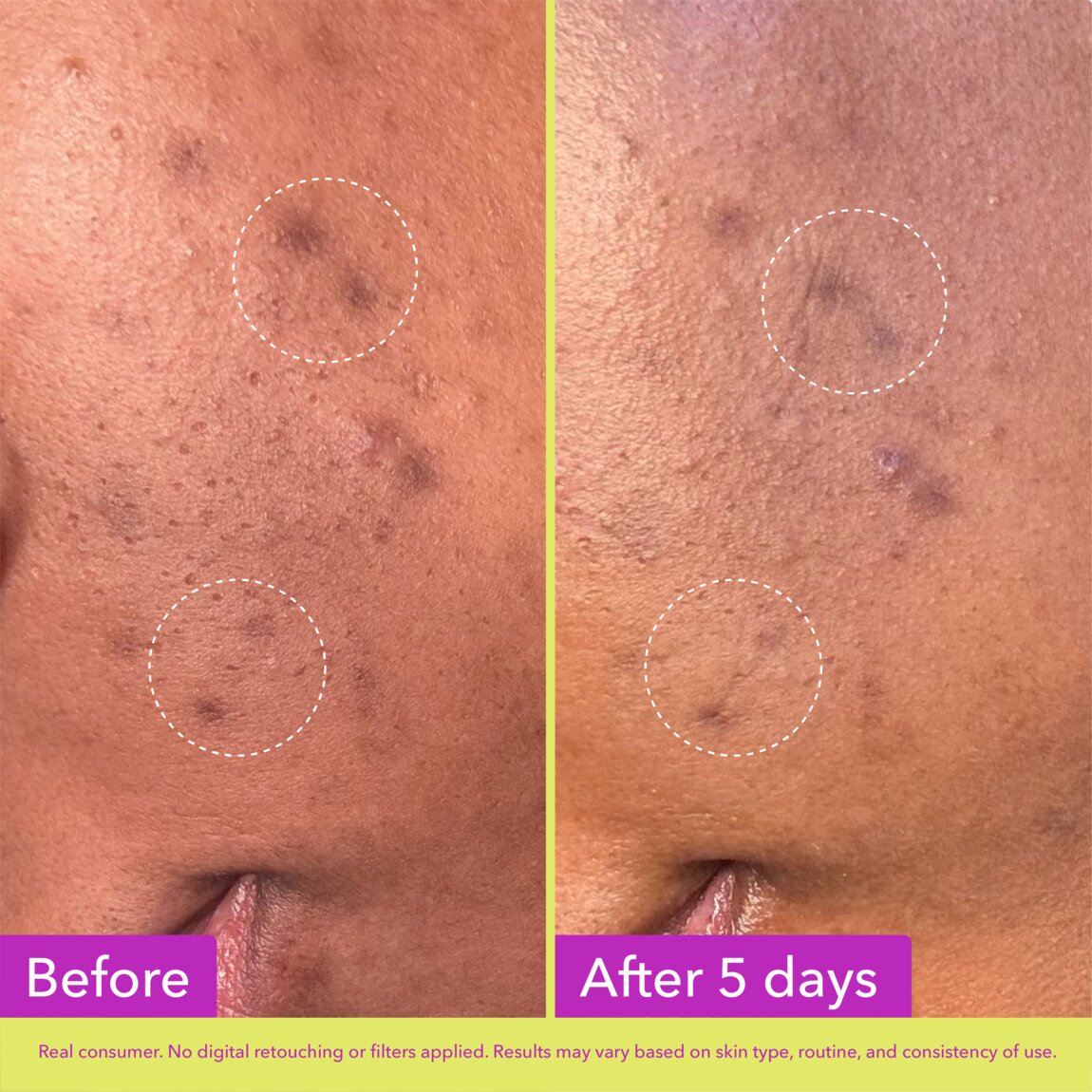 dark-spot-microdart-patches-r0 zb_p.jpg
