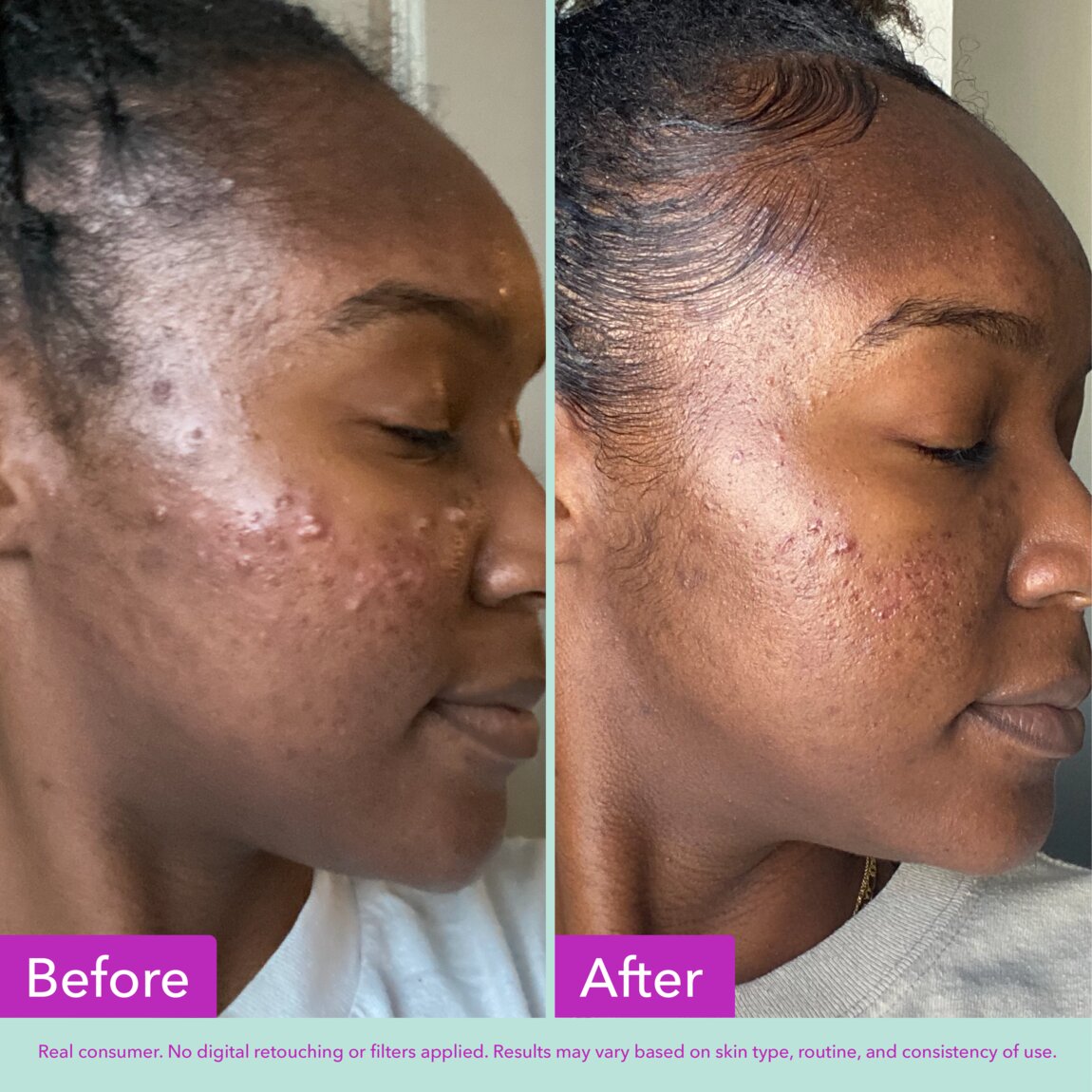 acne-foaming-cleanser-v1 zb_p.jpg